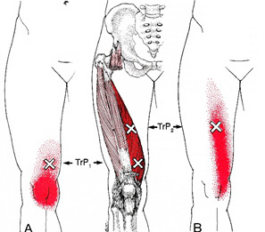 膝痛　トリガーポイント療法